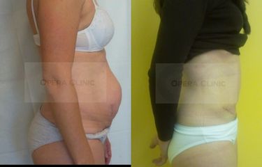 Abdominoplastika s plastikou popôrodnej diastázy
