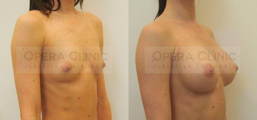 Augmentácia prsníkov, anatomické implantáty Polytech Replicon , objem 315 ml