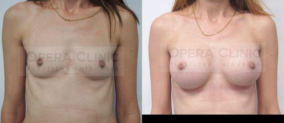 Zväčšenie prsníkov 350 cc Polytech anatomický implantát