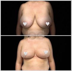 Modelácia prsníkov (Mastopexia) - OPERA CLINIC plastická a estetická chirurgia