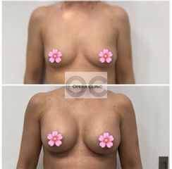 Zväčšenie prsníkov (Augmentácia) - OPERA CLINIC plastická a estetická chirurgia