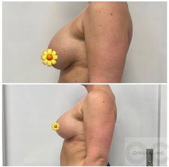 Modelácia prsníkov (Mastopexia) - OPERA CLINIC plastická a estetická chirurgia