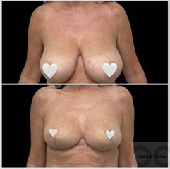 Modelácia prsníkov (Mastopexia) - OPERA CLINIC plastická a estetická chirurgia