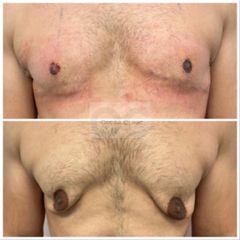 Operácia gynekomastie - OPERA CLINIC plastická a estetická chirurgia