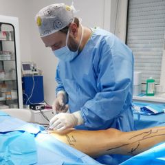 Laserova operacia krcovych zil