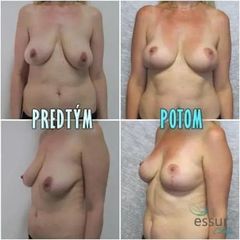 BEFORE mastopexia01 (1)