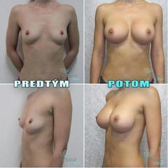 BEFORE augmentacia 001 1080 (1)