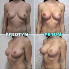 BEFORE augmentacia 002 1080