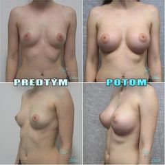 BEFORE augmentacia 004 1080