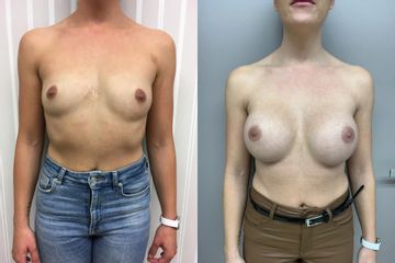 Augmentácia prsníkov s implantátom Motiva Ergonomix