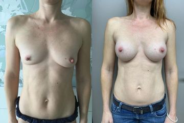 Augmentácia prsníkov s implantátom Motiva Ergonomix