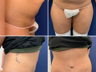 Abdominoplastika - 869042