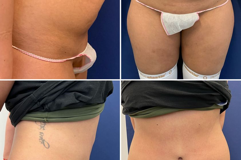 Abdominoplastika pred a po - 869042