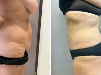 Abdominoplastika pred a po - 869061