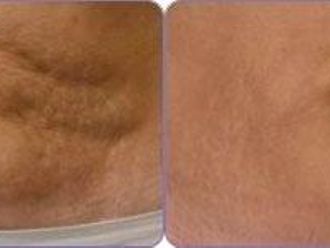 Odstránenie celulitídy pred a po - 805672