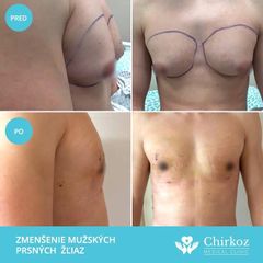 Gynecomastia - MUDr. Jana Kubicová-Košťálová