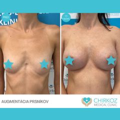 Zväčšenie pŕs - MUDr. Jana Kubicová-Košťálová