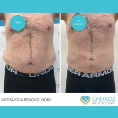 Liposukcia - MUDr. Jana Kubicová-Košťálová