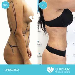 Liposukcia - MUDr. Jana Kubicová-Košťálová