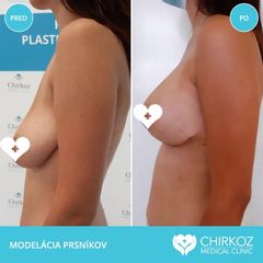 Mastopexia - MUDr. Jana Kubicová-Košťálová