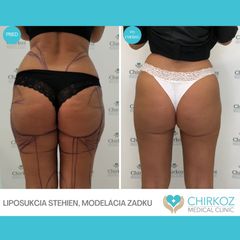 Liposukcia - MUDr. Jana Kubicová-Košťálová