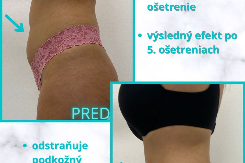 Neinvazívna liposukcia pred a po - 854548