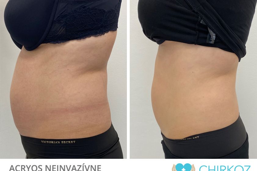 Neinvazívna liposukcia pred a po - 854557