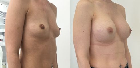 Zväčšenie prsníkov (Augmentácia) - MUDr. Darina Oravcová