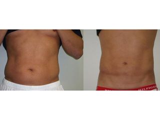 Liposukcia - MUDr. Martin Šimkanin