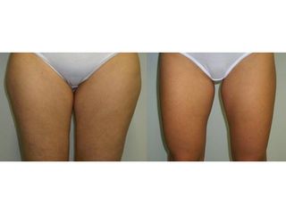 Liposukcia - MUDr. Martin Šimkanin