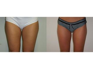 Liposukcia - MUDr. Martin Šimkanin