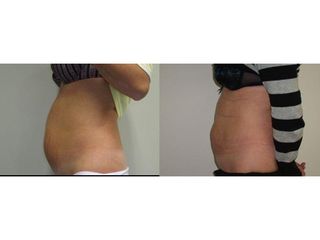 Liposukcia - MUDr. Martin Šimkanin