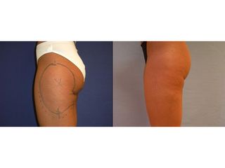 Liposukcia - MUDr. Martin Šimkanin