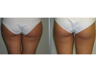 Liposukcia - MUDr. Martin Šimkanin