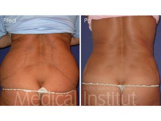Liposukcia - MUDr. Martin Šimkanin