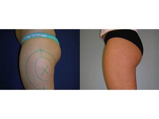 Liposukcia - MUDr. Martin Šimkanin