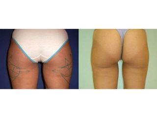 Liposukcia - MUDr. Martin Šimkanin