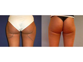 Liposukcia - MUDr. Martin Šimkanin