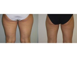 Liposukcia - MUDr. Martin Šimkanin