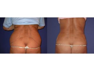 Liposukcia - MUDr. Martin Šimkanin