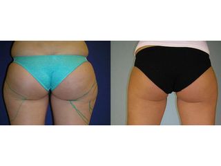 Liposukcia - MUDr. Martin Šimkanin
