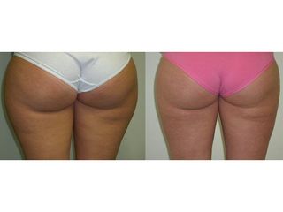 Liposukcia - MUDr. Martin Šimkanin