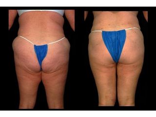 Liposukcia - MUDr. Martin Šimkanin