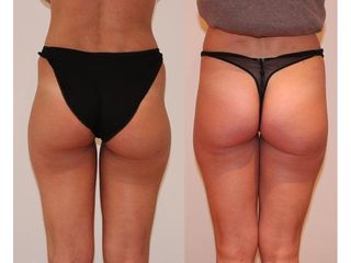 Liposukcia - MUDr. Martin Šimkanin