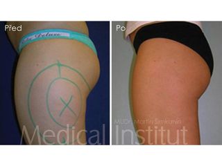 Liposukcia - MUDr. Martin Šimkanin