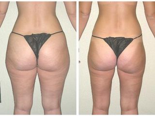 Liposukcia - MUDr. Martin Šimkanin
