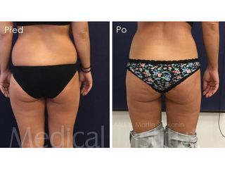 Liposukcia - MUDr. Martin Šimkanin
