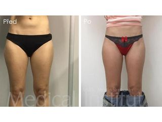 Liposukcia - MUDr. Martin Šimkanin