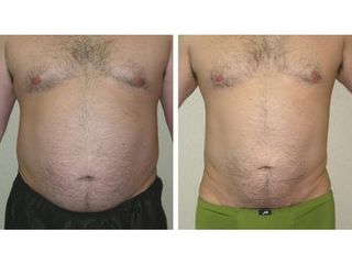 Liposukcia - MUDr. Martin Šimkanin
