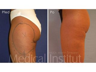 Liposukcia - MUDr. Martin Šimkanin